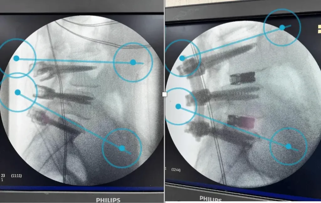 Imágenes de control radiológico de implantes espinales durante cirugía de columna