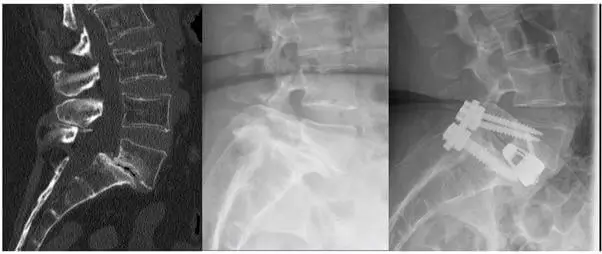 Imágenes preoperatorias y postoperatorias de artrodesis lumbar con colocación de implantes