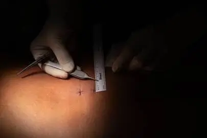 Marcaje preoperatorio en piel para cirugía de columna mínimamente invasiva