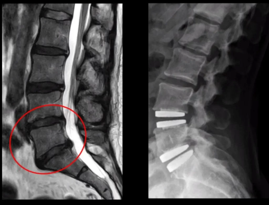 Comparación entre resonancia lumbar preoperatoria y radiografía postoperatoria tras artrodesis intersomática
