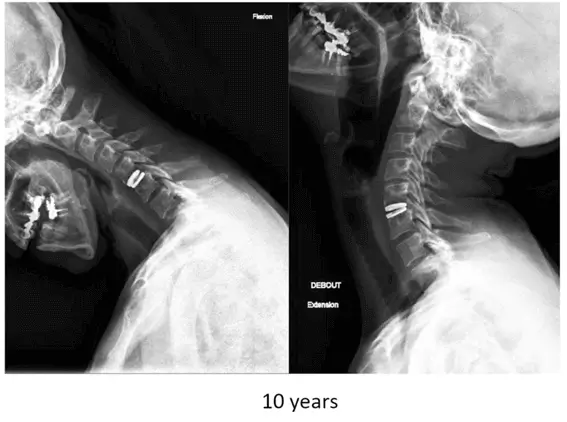 Radiografía cervical con prótesis de disco mostrando movilidad a 10 años de la cirugía