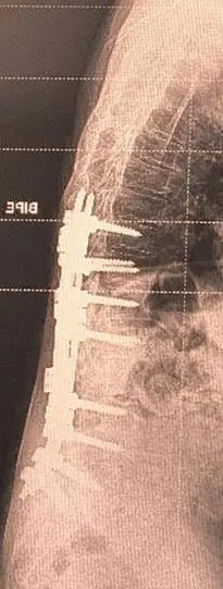 Radiografía de columna completa tras artrodesis multinivel en evaluación a largo plazo