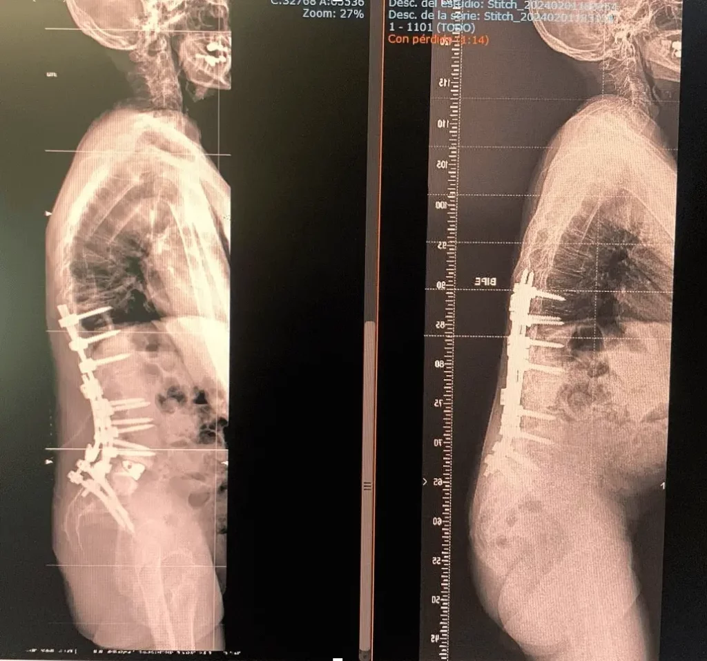 Radiografía lateral de columna vertebral con artrodesis multinivel en seguimiento a largo plazo