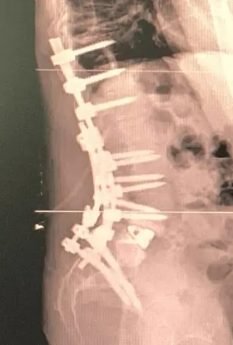 Radiografía lateral de artrodesis toracolumbar con múltiples tornillos e implantes