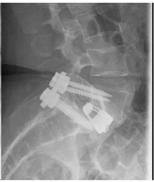Radiografía postoperatoria de columna lumbar con artrodesis e implantes vertebrales