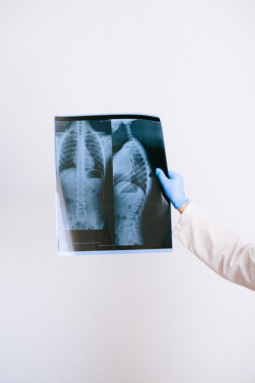 Radiografía lateral de columna con pérdida de lordosis lumbar